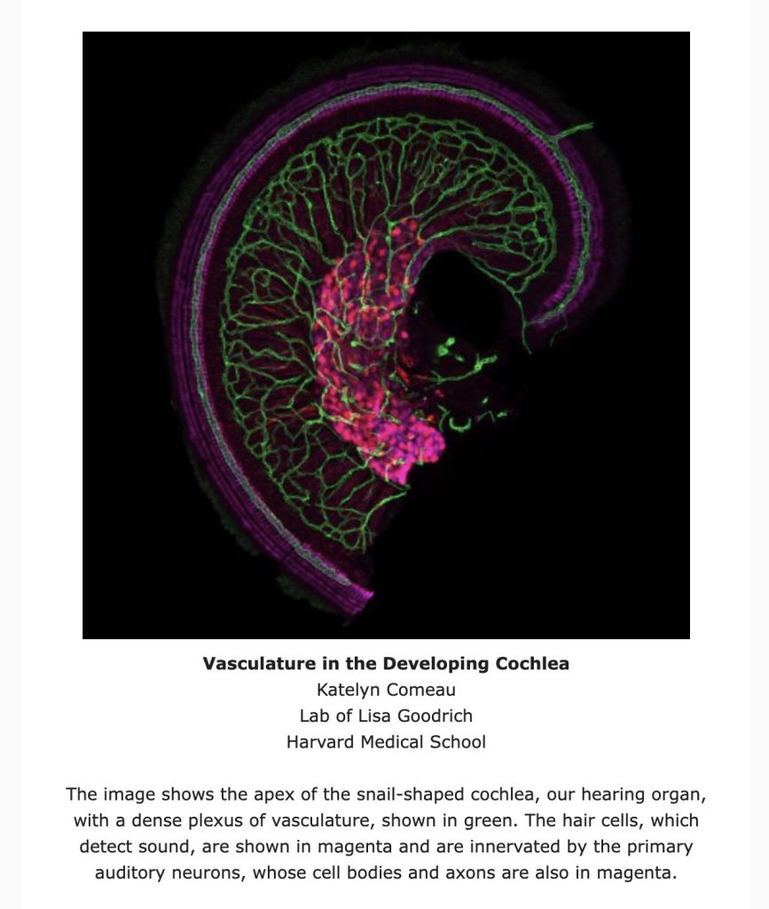 The cochlea, shaped like a snail, in the inner ear of a deaf(Katelyn Comeau/Harvard Medical School) 